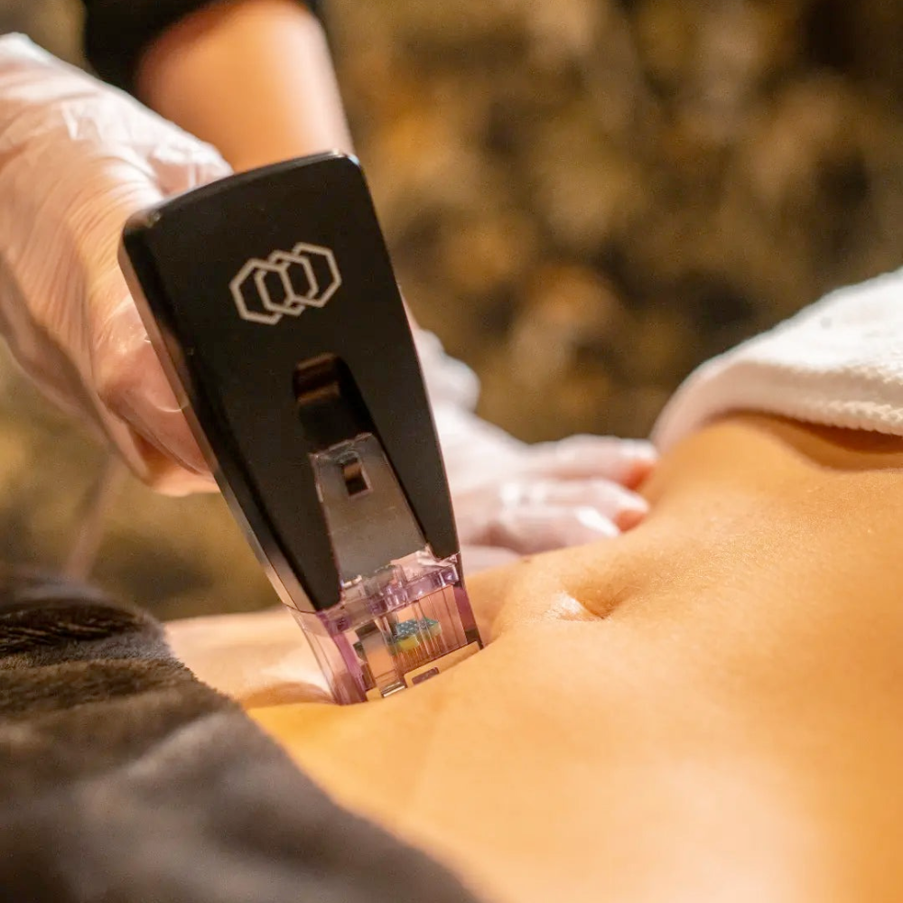 Morpheus8 Facial